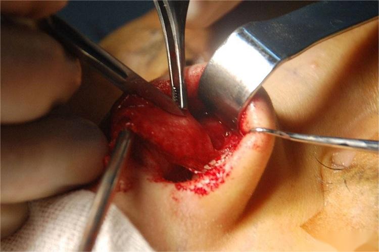 鼻翼软骨部分切除术图