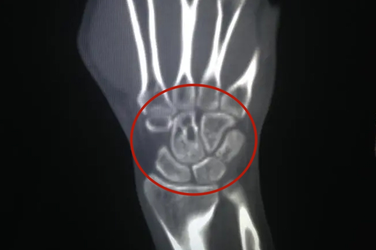 正常人手腕骨头CT图