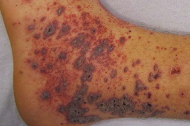 血小板增多性紫癜脚踝紫斑图