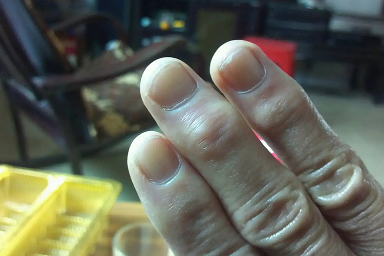 手指关节钙化图