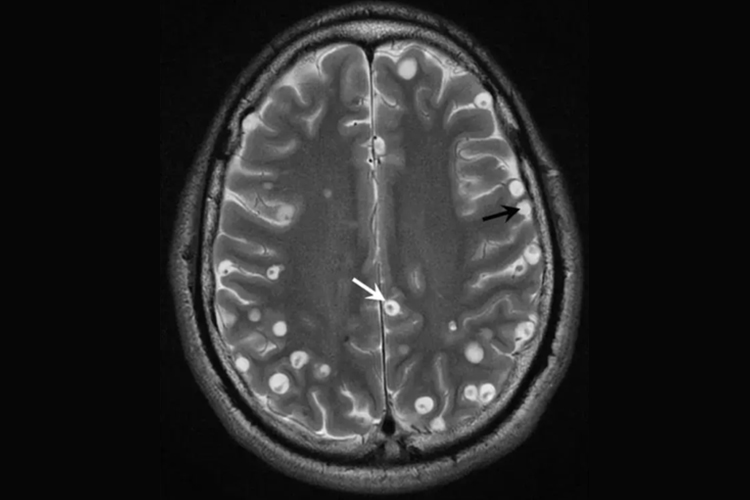 脑囊虫CT图 脑囊虫CT图
