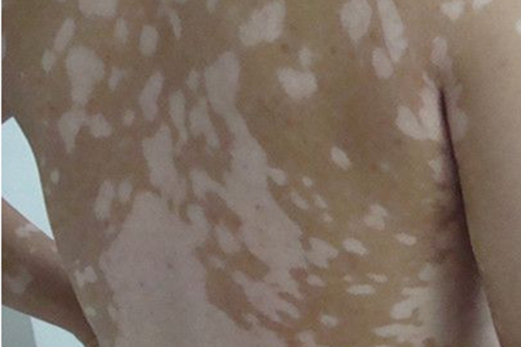 稳定期节段型白癜风白斑图 稳定期节段型白癜风白斑图