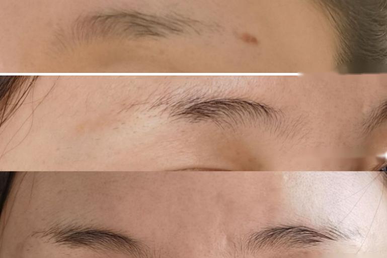 无创洗眉5-7天变化图