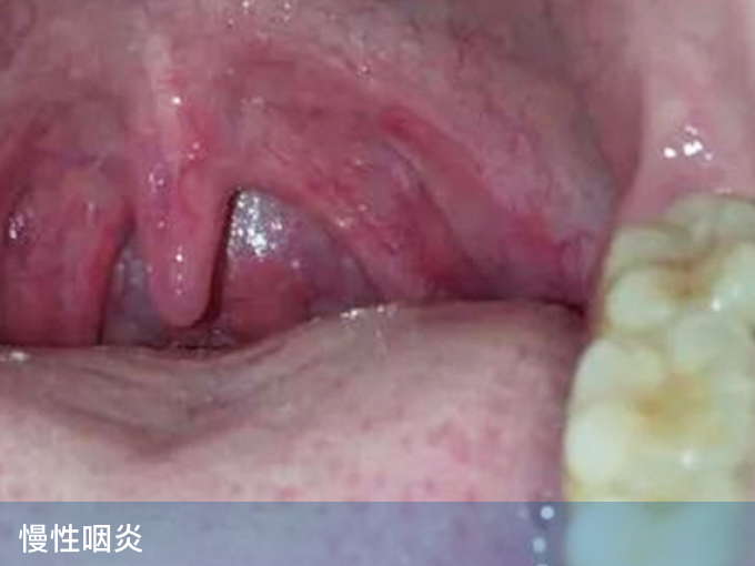 慢性咽炎