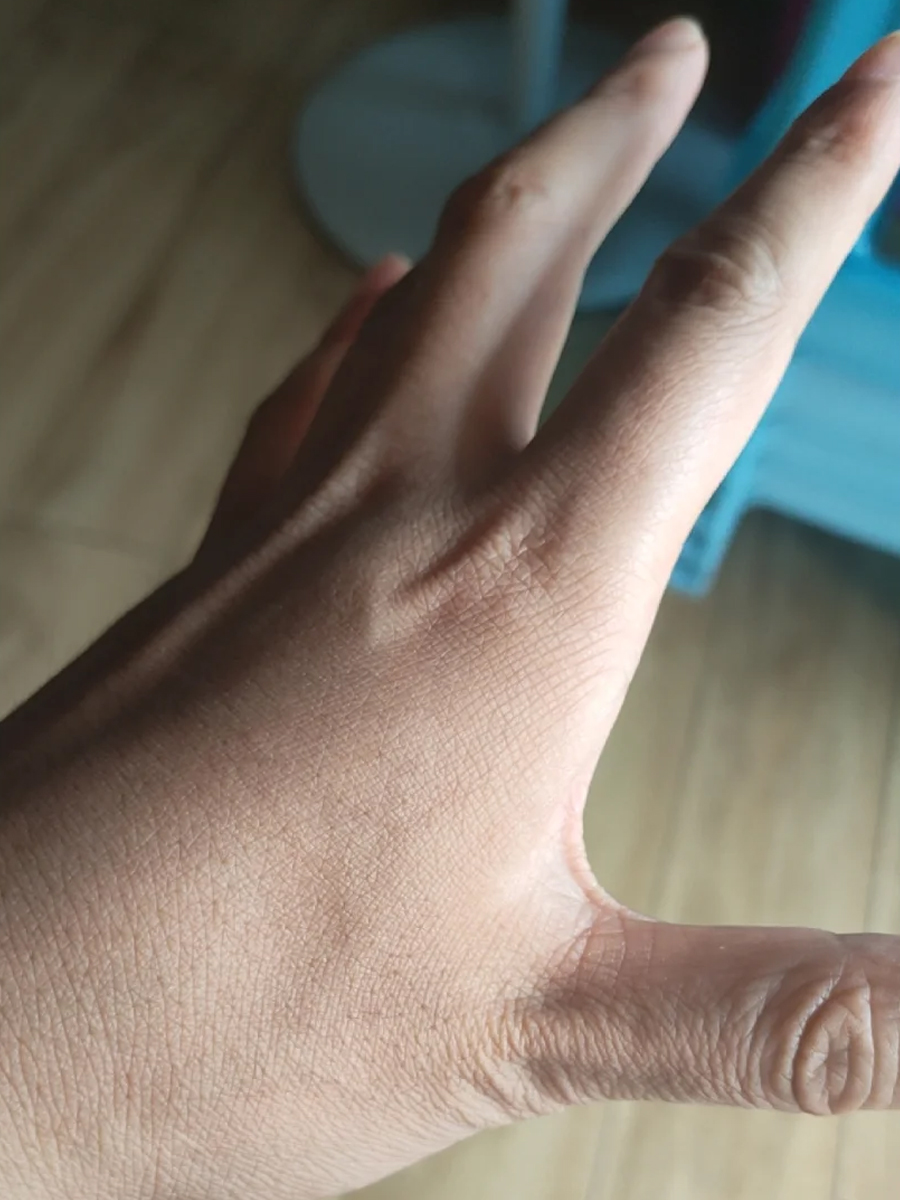 渐冻症预警|教你识别早期征兆