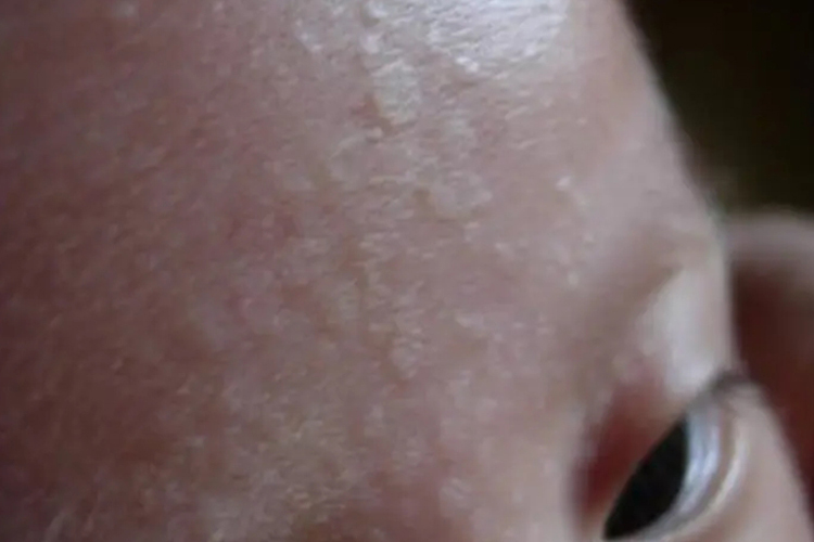 婴儿额头白色糠疹图 婴儿额头白色糠疹图