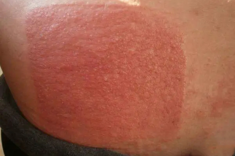 腰部接触性皮炎红疹瘙痒图