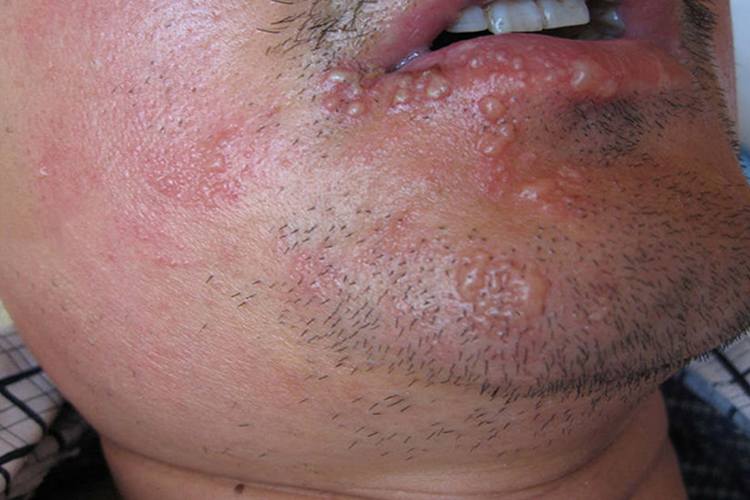 复发型口周水疱图