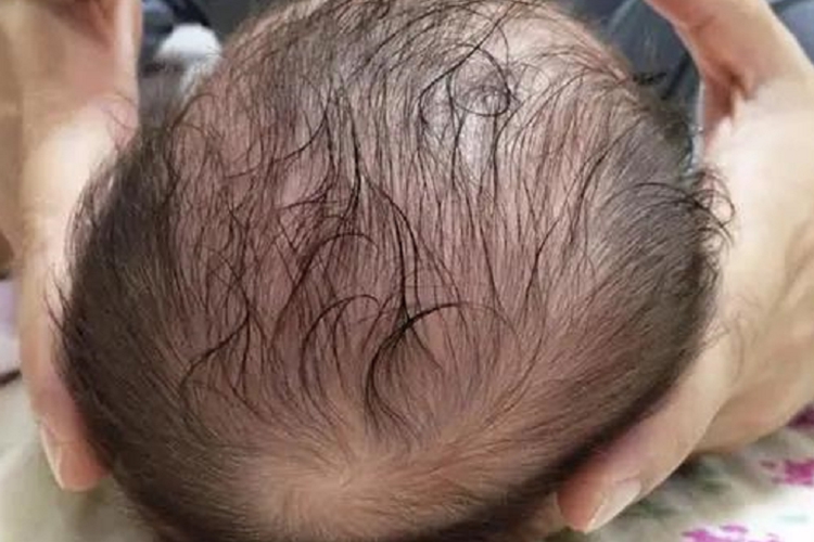 狭颅症斜头畸形图