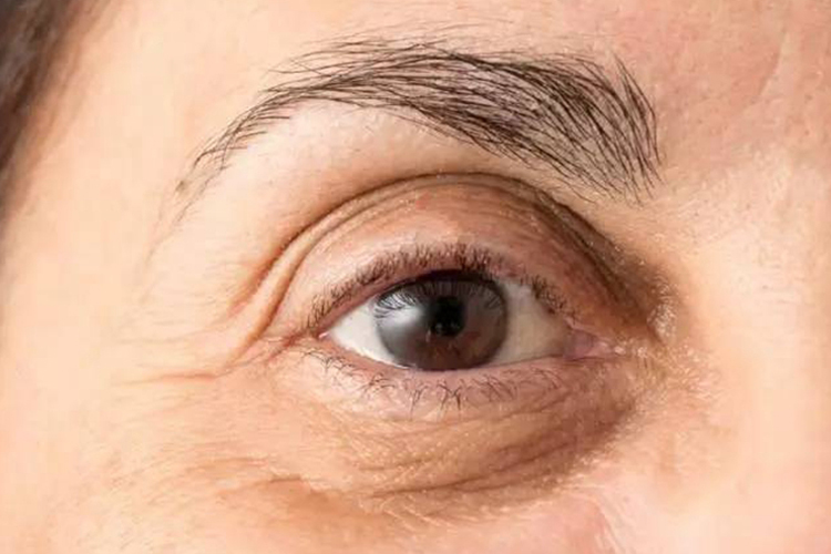 皮肤松弛下眼睑下垂图 皮肤松弛下眼睑下垂图