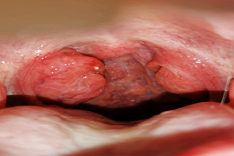 扁桃体二度肿大图