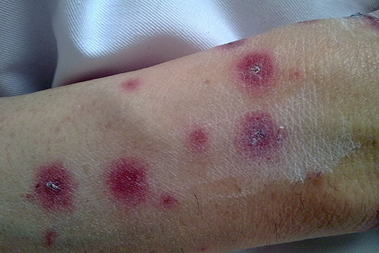 水疱-大疱型多形红斑图