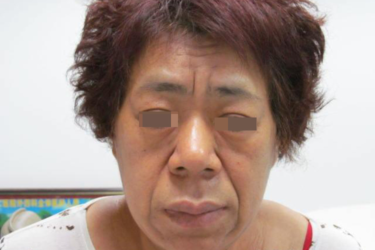 生长激素分泌型垂体瘤面容图