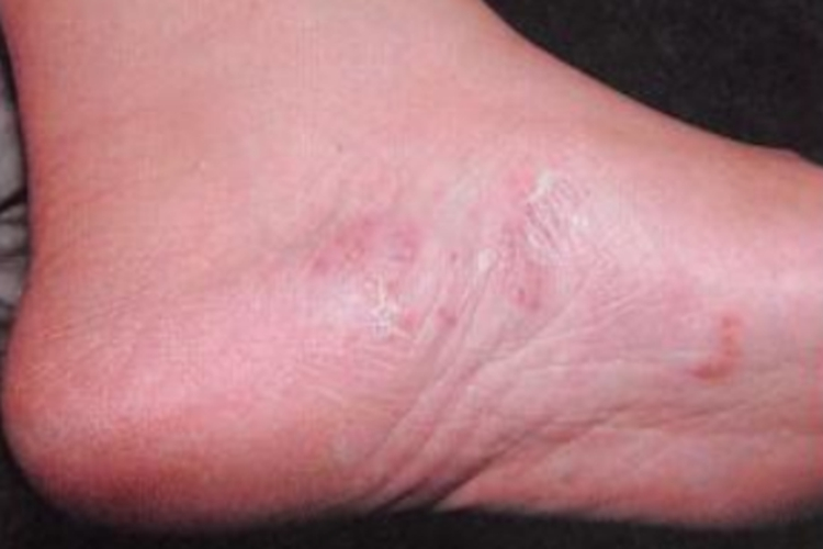 水泡型足癣图