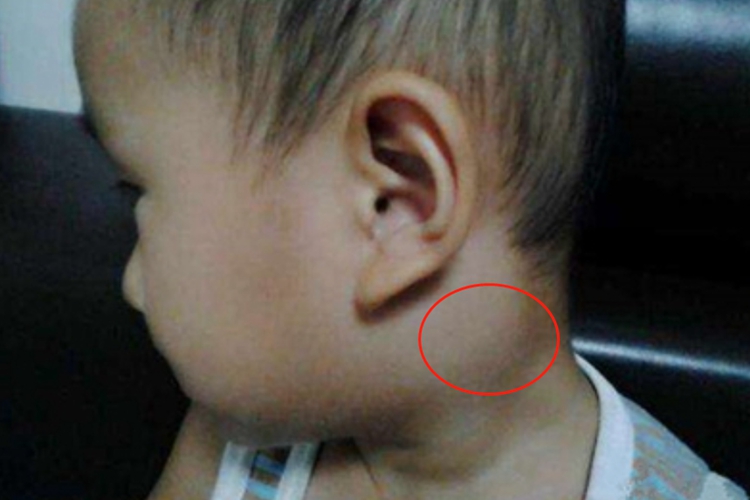 急性化脓性腮腺炎耳后症状图