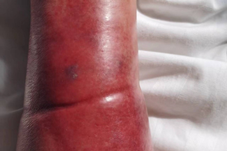 丹毒小腿有一大片红斑图