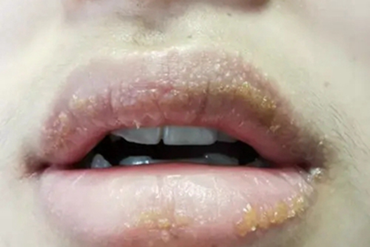 芒果皮炎嘴唇起水疱图