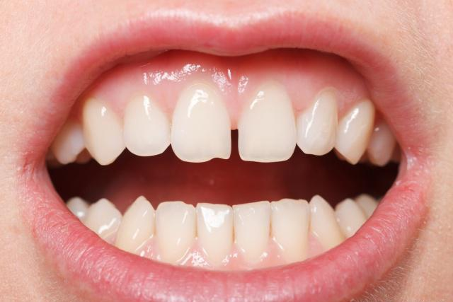 异常牙齿磨平前图