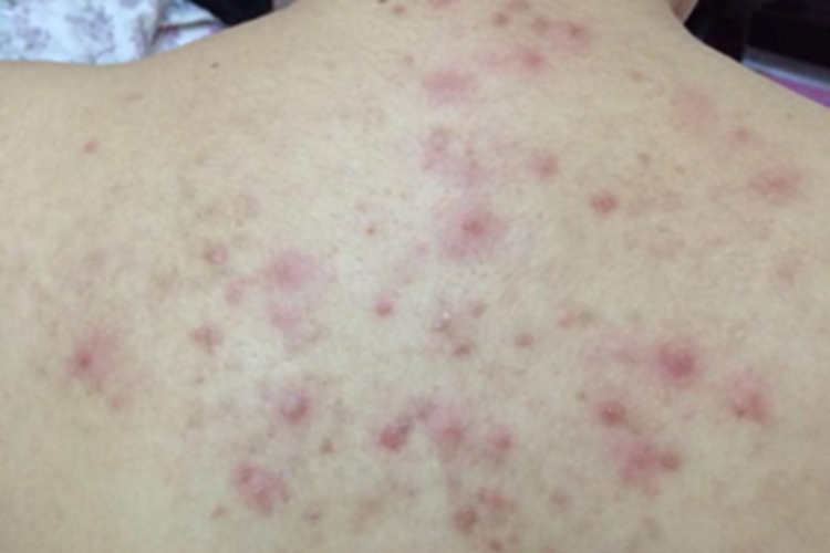 成人脂溢性皮炎背部红斑图 成人脂溢性皮炎背部红斑图