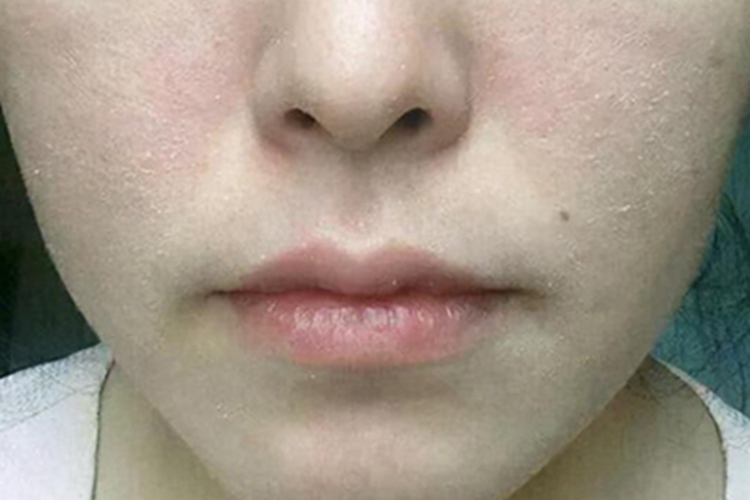 甲状腺功能减退症面部脱屑图