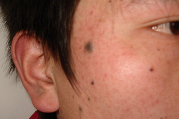 复合痣面部痣图