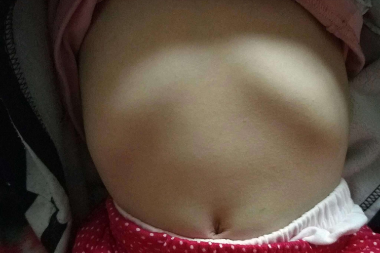 一岁宝宝肋骨畸形图 一岁宝宝肋骨畸形图