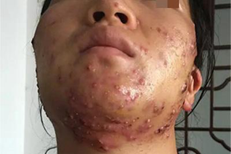 痤疮下巴脓包图