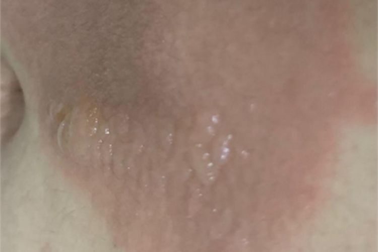 烫伤腹部症状图