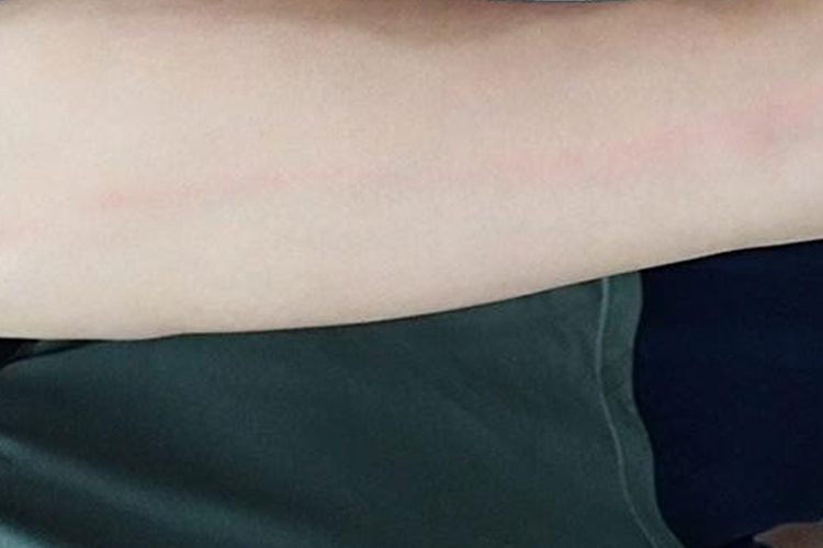 浅表性静脉炎图 浅表性静脉炎图