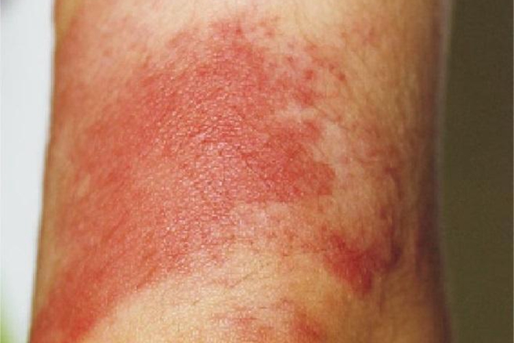 杆菌性血管瘤脚踝症状图 杆菌性血管瘤脚踝症状图