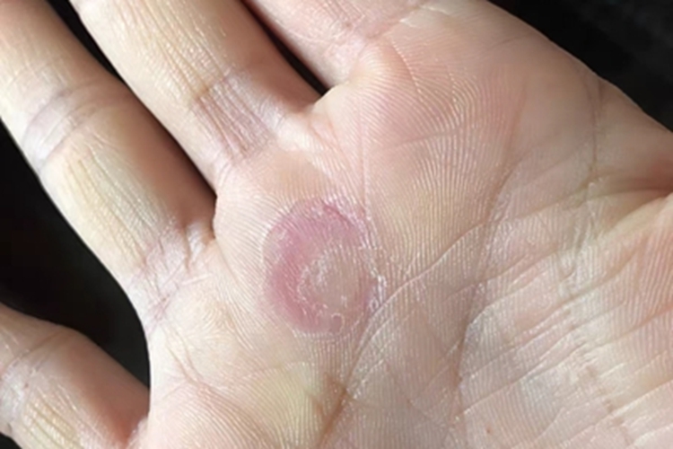 鳞屑角化型手癣手掌脱皮图