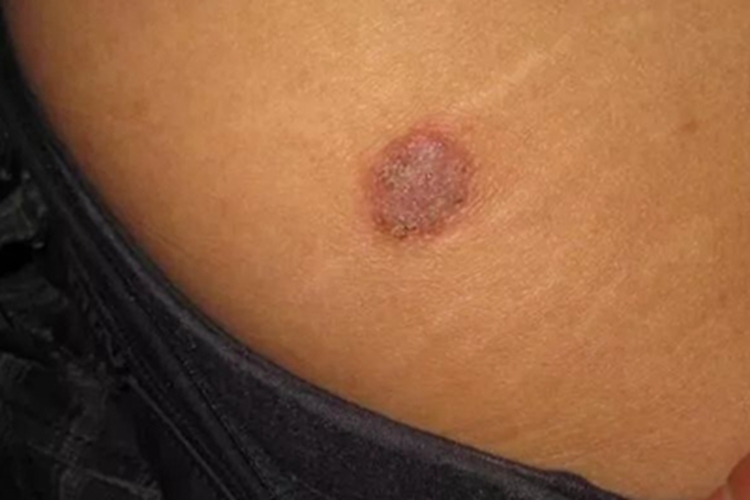 钱币状湿疹腰部结痂图 钱币状湿疹腰部结痂图