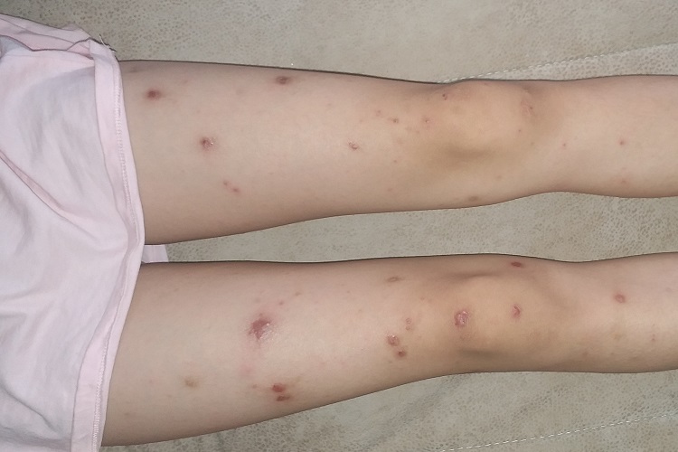 女性梅毒腿部症状图 女性梅毒腿部症状图