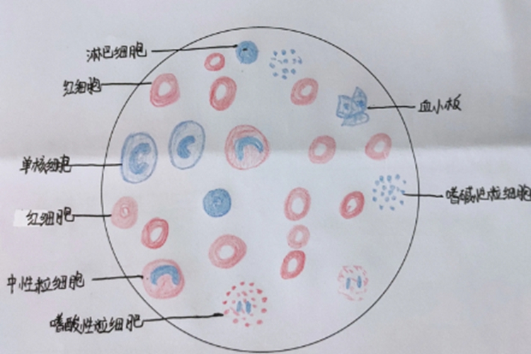 急性单纯性阑尾炎红蓝铅笔手绘图