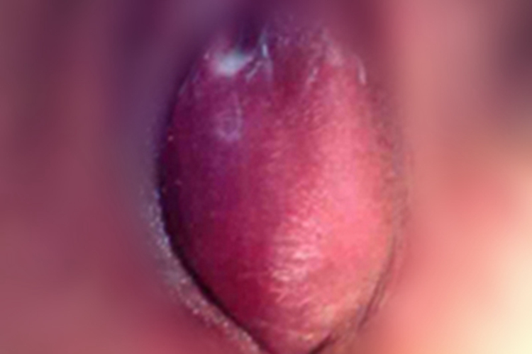 前庭大腺囊肿会阴部肿块图 前庭大腺囊肿会阴部肿块图