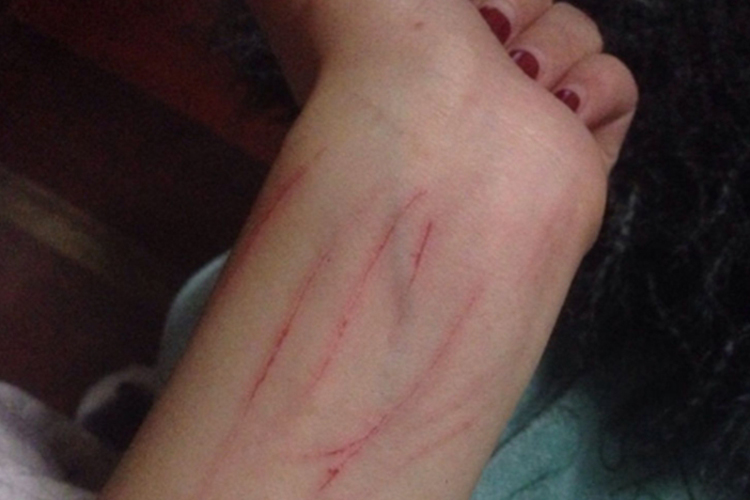 抓伤手腕血痂图