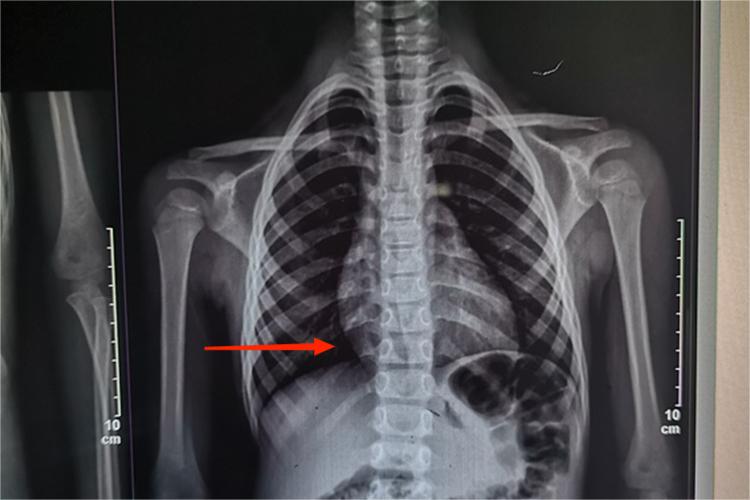 轻度脊柱侧弯影像图