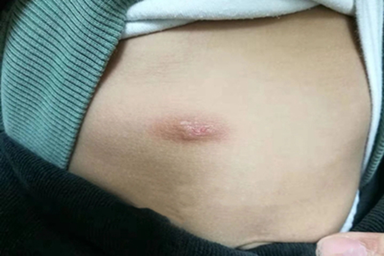 皮肤肥大细胞瘤症状图 皮肤肥大细胞瘤症状图