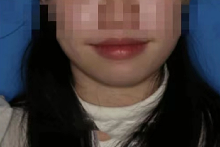 牙齿矫正后脸型外观图