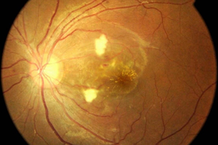 恶性高血压视网膜病变血丝图 恶性高血压视网膜病变血丝图