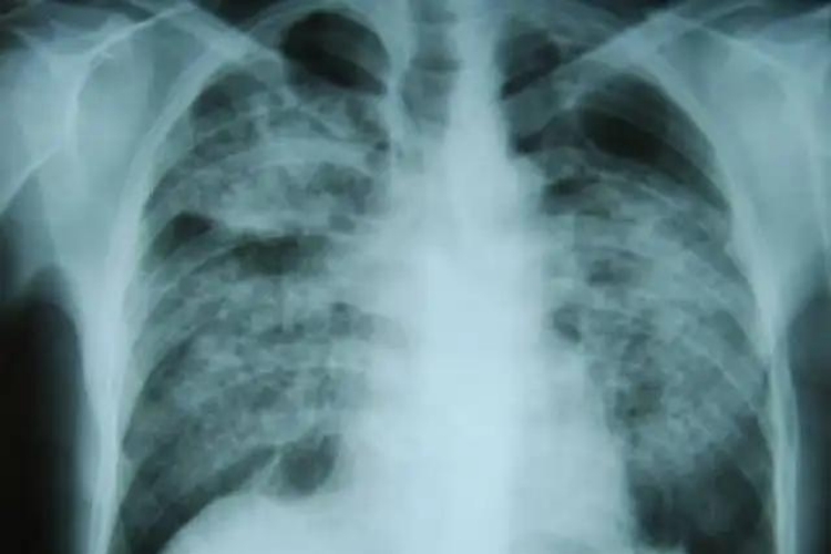 尘肺病肺部影像图 尘肺病肺部影像图