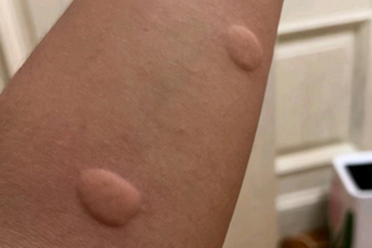 接触性荨麻疹胳膊症状图