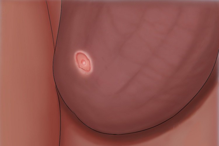 男性二期梅毒阴囊溃疡手绘图 男性二期梅毒阴囊溃疡手绘图