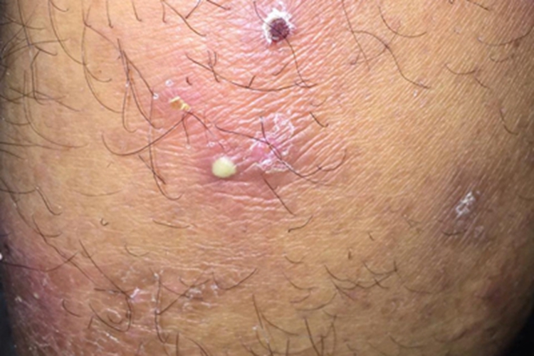 嗜酸性脓疱性毛囊炎大腿脓包图 嗜酸性脓疱性毛囊炎大腿脓包图