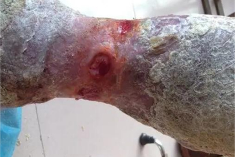 臁疮小腿结痂图 臁疮小腿结痂图