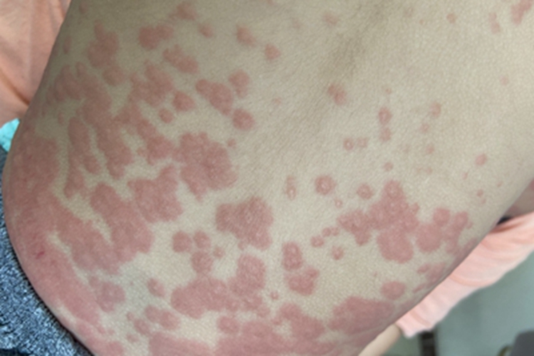 荨麻疹型药疹腰部症状图 荨麻疹型药疹腰部症状图