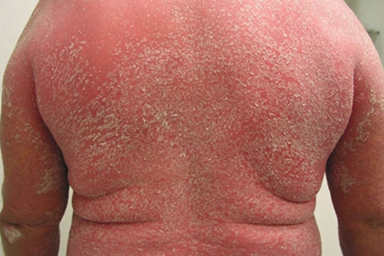 松皮癣背部脱屑图 松皮癣背部脱屑图