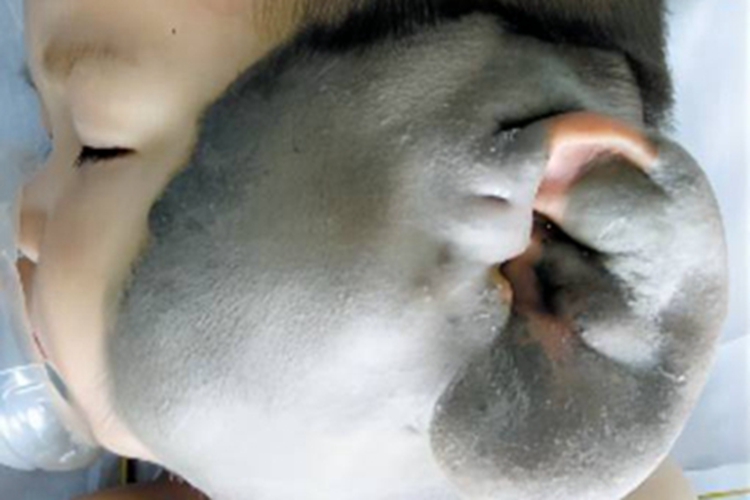 口腔颌面部恶性黑色素瘤面部瘤图 口腔颌面部恶性黑色素瘤面部瘤图