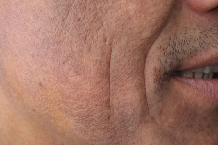 皮肤黑变病脸上紫黑色图