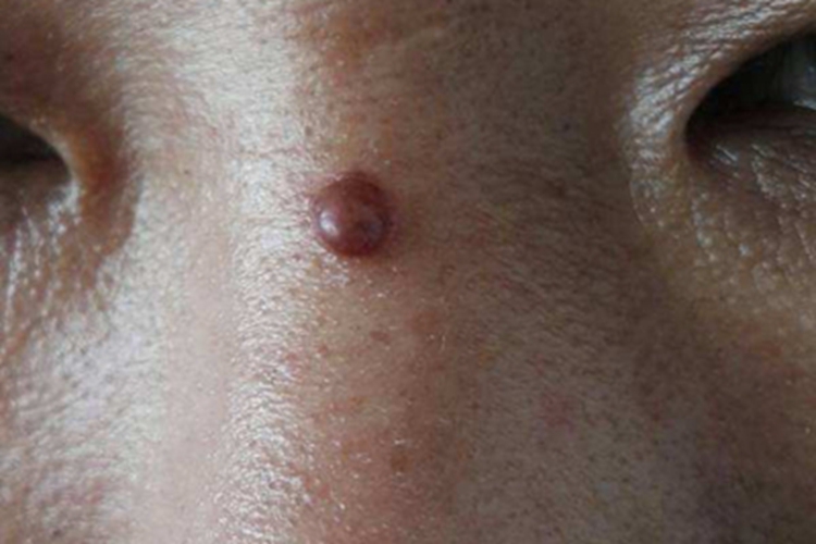 小汗腺汗孔瘤鼻梁根部有肉球图